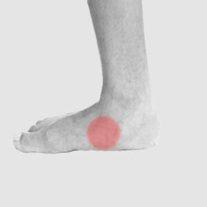 Flat feet treatment with custom insoles and footwear