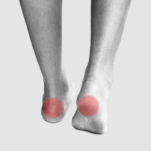 Heel pain treatment and plantar fasciitis insoles